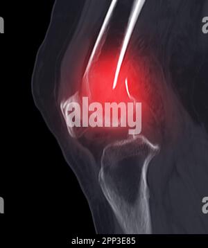 CT-Scan des Kniegelenkes mit Fraktur des distalen Femurknochens. Stockfoto