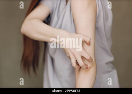 Allergische Dermatologie Skabies Juckreiz Hand Hautproblem Frau Stockfoto