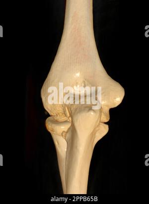 CT-Darstellung der 3D-Darstellung des Ellenbogengelenkes. Stockfoto