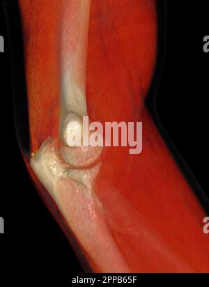 CT-Darstellung der 3D-Darstellung des Ellenbogengelenkes. Stockfoto