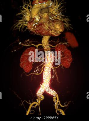 CTA-Ganzaorta mit abdominalem Aortenstent-3D-Rendering bei abdominellen Aortenaneurysmen. Stockfoto