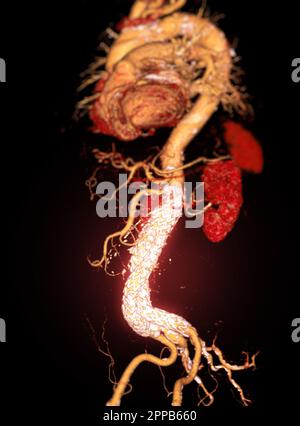 CTA-Ganzaorta mit abdominalem Aortenstent-3D-Rendering bei abdominellen Aortenaneurysmen. Stockfoto