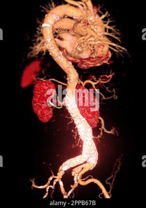 CTA-Ganzaorta mit abdominalem Aortenstent-3D-Rendering bei abdominellen Aortenaneurysmen. Stockfoto