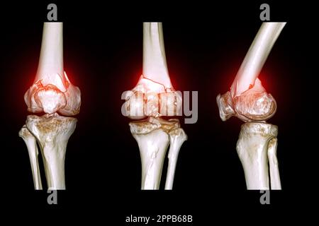 CT-Scan des Kniegelenkes mit 3D-Rendering-Darstellung der Fraktur des distalen Femurknochens. Stockfoto