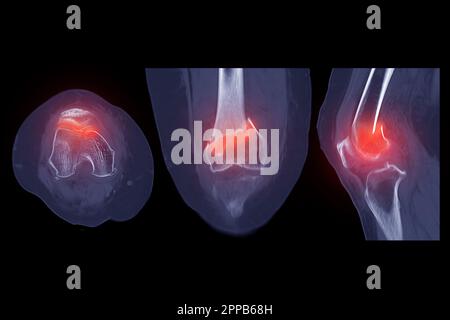 CT-Scan des Kniegelenkes mit 3D-Rendering-Darstellung der Fraktur des distalen Femurknochens. Stockfoto