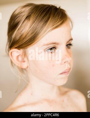 Windpocken, Varizellen-Virus oder vesikulärer Ausschlag auf Körper und Gesicht von kleinen Mädchen. Nahaufnahme von Kid mit roten Pickel Stockfoto