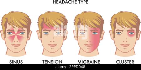 Illustration von Kopfschmerztypen Stock Vektor