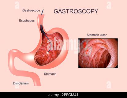 Verdauungsendoskopie oder Gastroskopie. Durchführung einer Gastroskopie. Diagnostik von Magenerkrankungen. Magengesundheit. Stockfoto