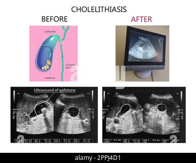 Sonographische Darstellung der Gallenblase mit Gallensteinen im Oberbauch. Gallensteinkonzept Stockfoto