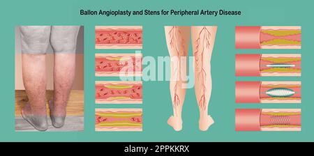 Das Diagramm zeigt Angioplastie für periphere Arterie Krankheit illustration Stockfoto