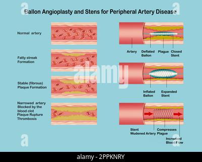 Angioplastie. Stentimplantation. Deflatierter Ballonkatheter in eine plaqueverengte Koronararterie eingeführt. Der Ballon wird aufgeblasen und drückt Plaque gegen die Arterienwand Stockfoto