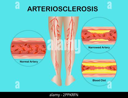 Menschliche Beine. Arterie mit Verfall der Blutzellen. Konzept der trockenen Haut, alte Senioren Stockfoto