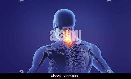 Animation eines schmerzhaften Nackens Stockfoto