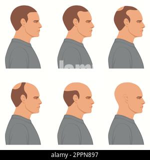 Haarverluststadien Vektor isoliert. Die männliche Alopezie. Satz des Glättungsprozesses. Haarlose Männerköpfe, Seitenansicht. Stock Vektor