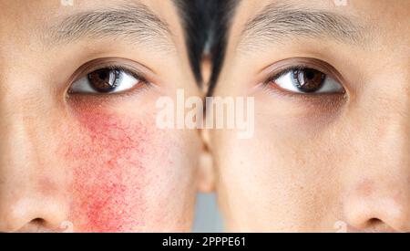 Vor und nach einer Behandlung der akneiformen Rosazea bei einem asiatischen männlichen Gesicht. Couperose auf den Wangen und eines jungen asiatischen Mannes Stockfoto