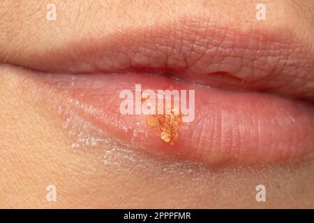 Makro von Lippen der Frau mit Lippenherpes. Herpes-simplex-Pusteln-Nahaufnahme bei einer weiblichen Mundhöhle. Stockfoto