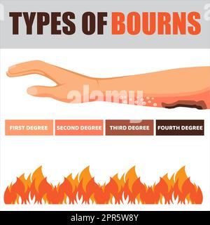 Hautverbrennungsverletzung Behandlung und Stadien Infografik. Schäden durch Feuer. Rote Haut. Isolierte Vektorgrafik im Cartoon-Stil Stockfoto