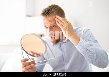 Alopezie Mann Haarausfall Stockfoto