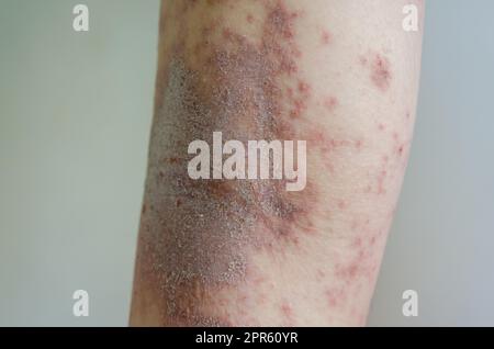 Rote Hautausschlag Mädchen Hauterkrankung durch Allergien auf Medikamente, Lebensmittel, Chemikalien, schlechtes Immunsystem in der Lymphe verursacht. Stockfoto