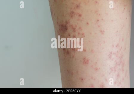 Rote Hautausschlag Mädchen Hauterkrankung durch Allergien auf Medikamente, Lebensmittel, Chemikalien, schlechtes Immunsystem in der Lymphe verursacht. Stockfoto