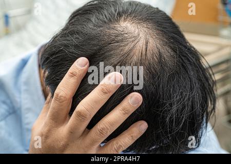 Glatze in der Mitte Kopf und beginnen keinen Verlust Haar glabrous der reifen asiatischen Geschäft smart aktiven Büromann. Stockfoto
