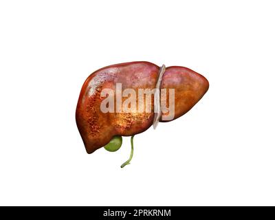 Realistische Illustration krank Zirrhose menschliche Lebern , beschädigte Leber, übermäßigen Alkoholkonsum, Behandlung, 3D Rendering Stockfoto