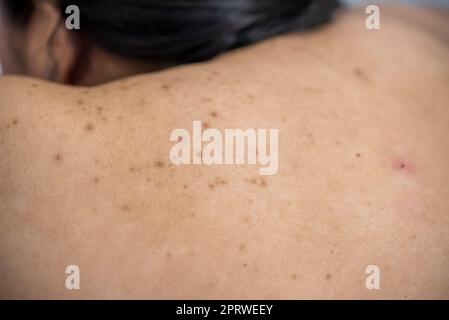Akne auf der Rückseite der Hautpflege Frau wird durch Bakterien verursacht. Stockfoto