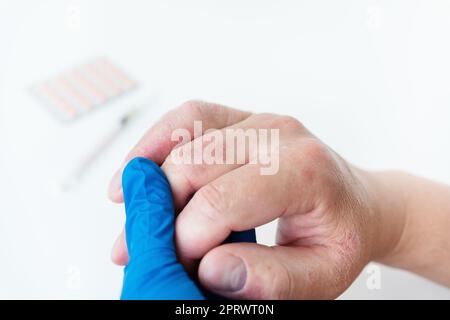 Ein Mann zeigt dem Arzt einen geröteten Ausschlag an den Händen. Ursachen für Juckreiz können Dermatitis (Ekzem), trockene Haut, Verbrennungen, Lebensmittelallergien sein. Gesundheitskonzept. Stockfoto