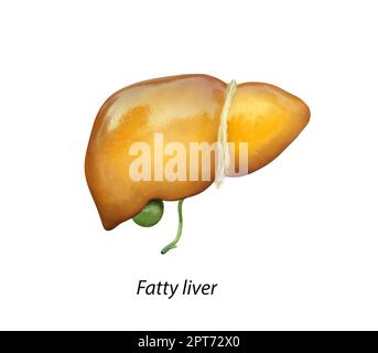 Fettleber, Lebersteatose, tritt es bei Alkoholübergebrauch auf, unter Einwirkung von Giftstoffen, geschädigter Leber, Fettleber, übermäßigem Alkoholkonsum, Behandlung von Männern Stockfoto