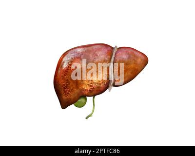 Realistische Illustration krank Zirrhose menschliche Lebern , beschädigte Leber, übermäßigen Alkoholkonsum, Behandlung, 3D Rendering Stockfoto
