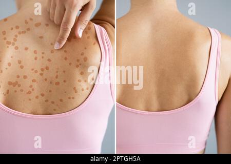 Psoriasis-Borreliose Behandlung Vor Nach. Hautausschlag In Der Dermatologie Stockfoto