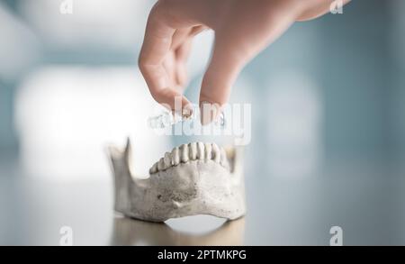 Die Frau legt mit ihrer Hand einen durchsichtigen kieferorthopädischen Stricher auf einen Zahnabdruck. Die Kunststoffform dient zum Einstellen der Zähne Stockfoto