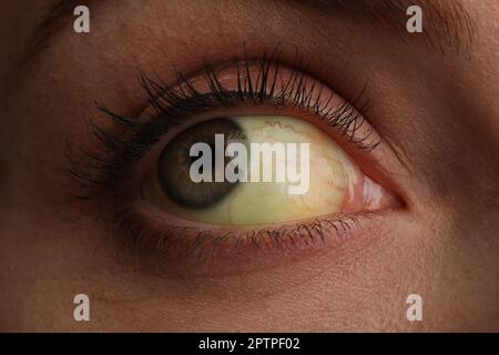 Frau mit gelben Augen, Nahaufnahme. Symptom Leberprobleme Stockfoto