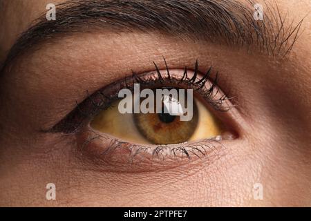 Frau mit gelben Augen als Hintergrund, Nahaufnahme. Symptom Leberprobleme Stockfoto