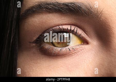 Frau mit gelben Augen als Hintergrund, Nahaufnahme. Symptom Leberprobleme Stockfoto