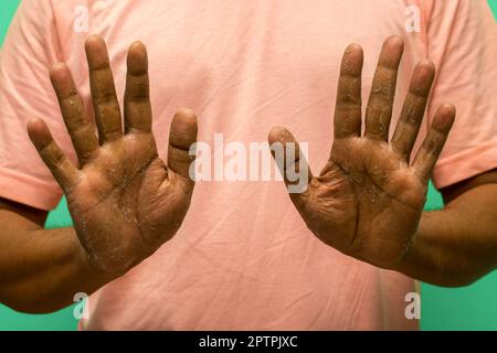 Exfoliative Keratolyse, fokale palmarschälende Hauterkrankung. Stockfoto