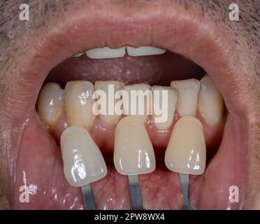 Nahaufnahme des Mundes. Arzt passt Zahnfarbe mit Farbpalette an. Ästhetische Zahnheilkunde Stockfoto