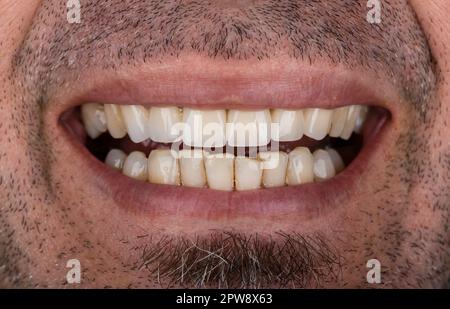 Nahaufnahme männlicher Zähne. Zirkonkronenoberzähne Stockfoto