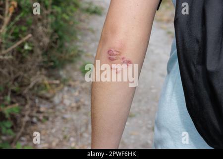 Arm einer Frau mit Hautausschlag an ihren Ellbogen, die als Stresstherapie auf dem Land spazieren geht Stockfoto