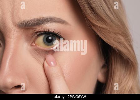 Frau mit gelben Augen, Nahaufnahme. Symptom Leberprobleme Stockfoto