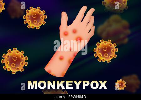 Person erkrankt von Affenpockenvirus, Illustration. Gefährliche Krankheit Stockfoto
