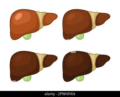 Stadien der Leberschädigung oder Krankheit Vektor-Illustrationen Set Stock Vektor