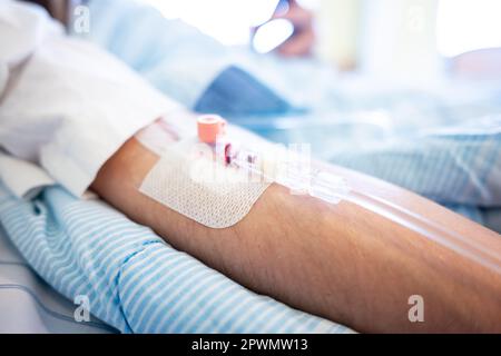 Venenkatheter am Patienten vor einer Operation Stockfoto