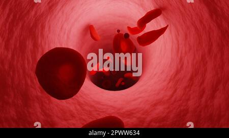 Venentunnel. Sichelzellen zirkulieren in Venen. Erythrozyten und Thrombozyten. Blutzellen, die sich durch eine Vene bewegen. 3D-Rendern. Stockfoto