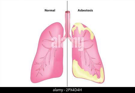 Asbestose Stock Vektor