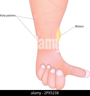 Bullöses Pemphigoid Stock Vektor