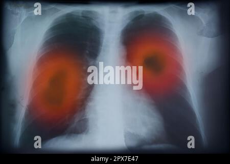 Röntgenbild eines Patienten mit Lungenkarzinom. Illustration Stockfoto
