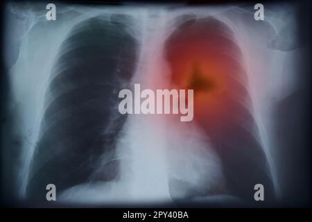 Röntgenbild eines Patienten mit Lungenkarzinom. Illustration Stockfoto