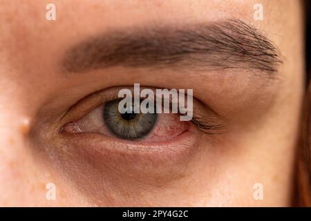 Porträt eines weiblichen Gesichts mit allergischer Haut und Augenbrauenkorrektur zu Hause ohne Allergie eines Kosmetikers Stockfoto