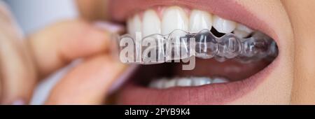 Durchsichtiger Aligner Dental Night Guard Stockfoto